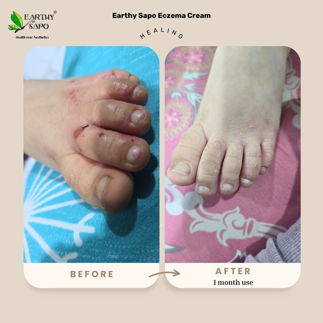 Earthy Sapo Eczema Cream before and after results showing improved appearance of dry, irritated skin after 1 month of use
